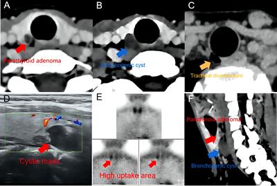 Frontiers Case Report Successful Treatment Of A Rare Case Of